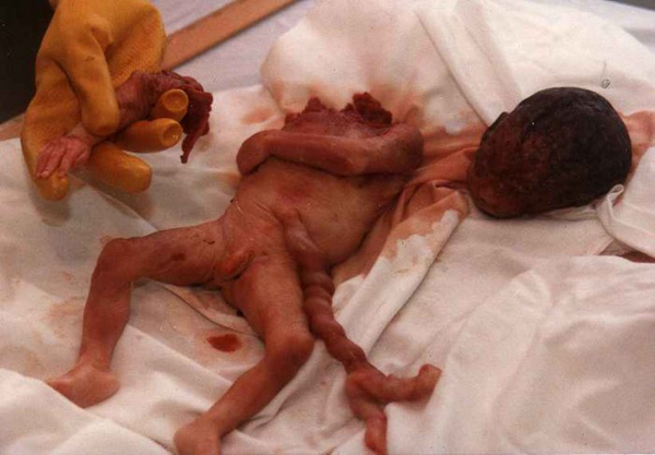 DecapitatedBaby1